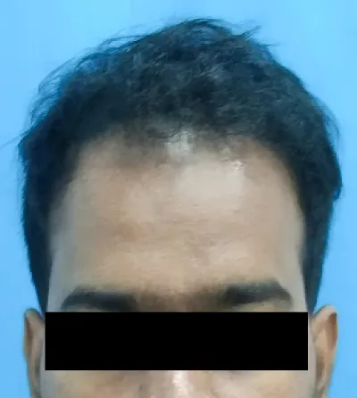 Activated Follicular Transplant Result After in VCare